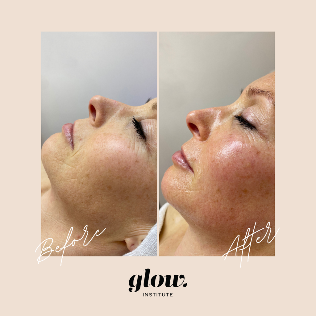 Bindweefselmassage voor en na