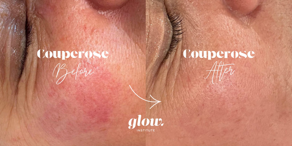 Couperose behandeling voor en na
