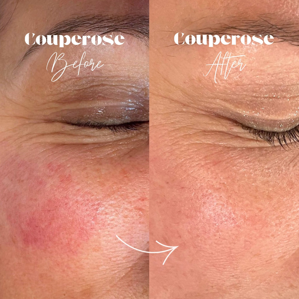 Couperose behandeling voor en na