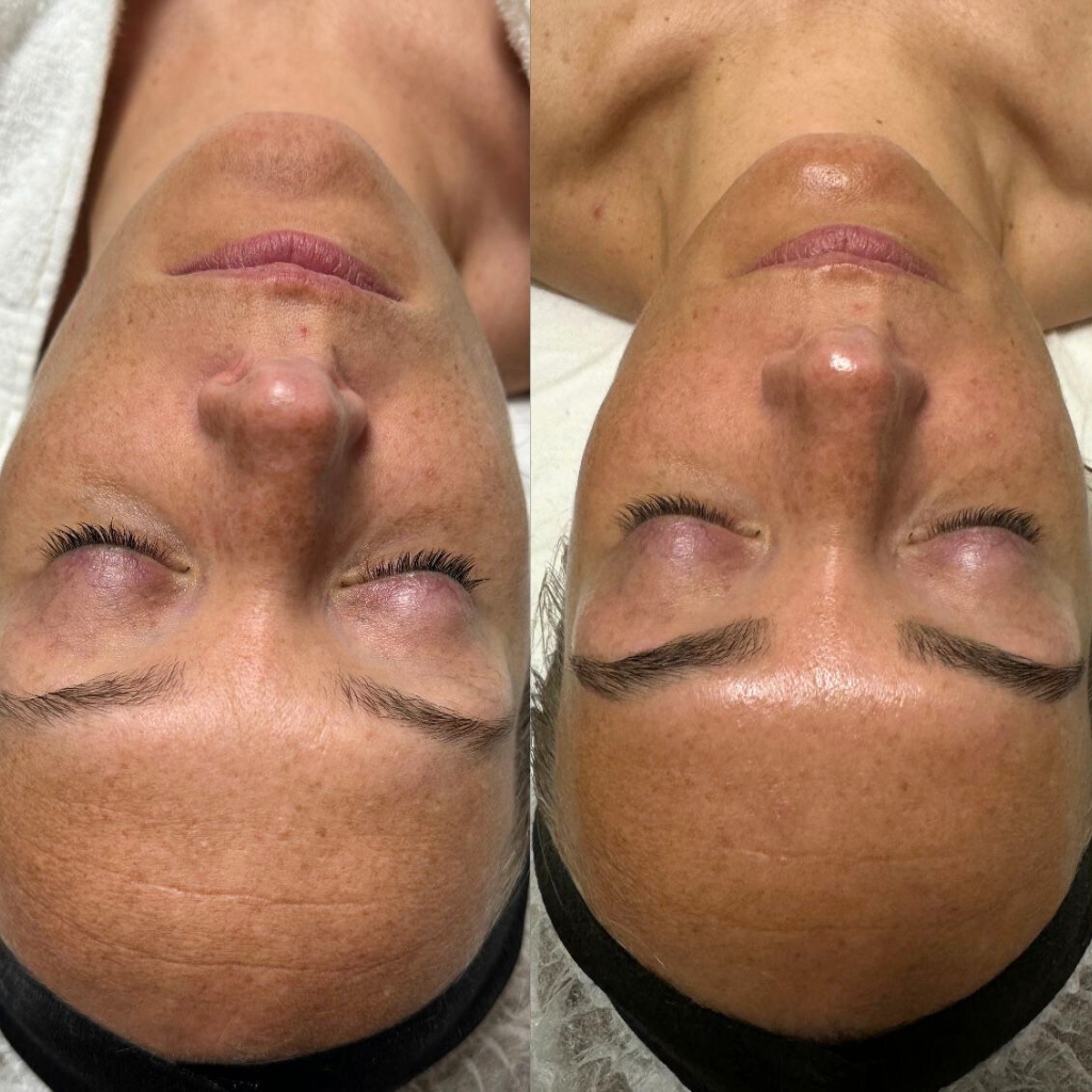 wallen behandeling voor en na