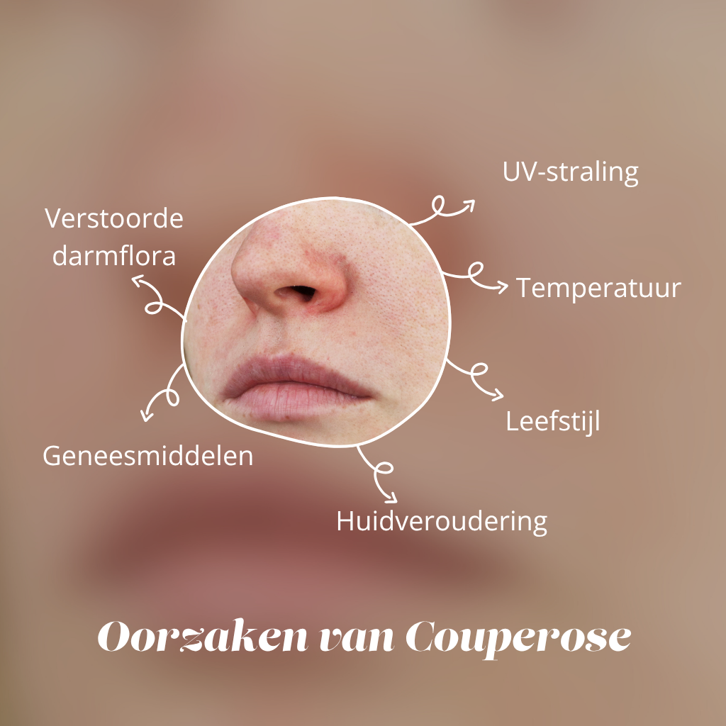 Oorzaken van couperose