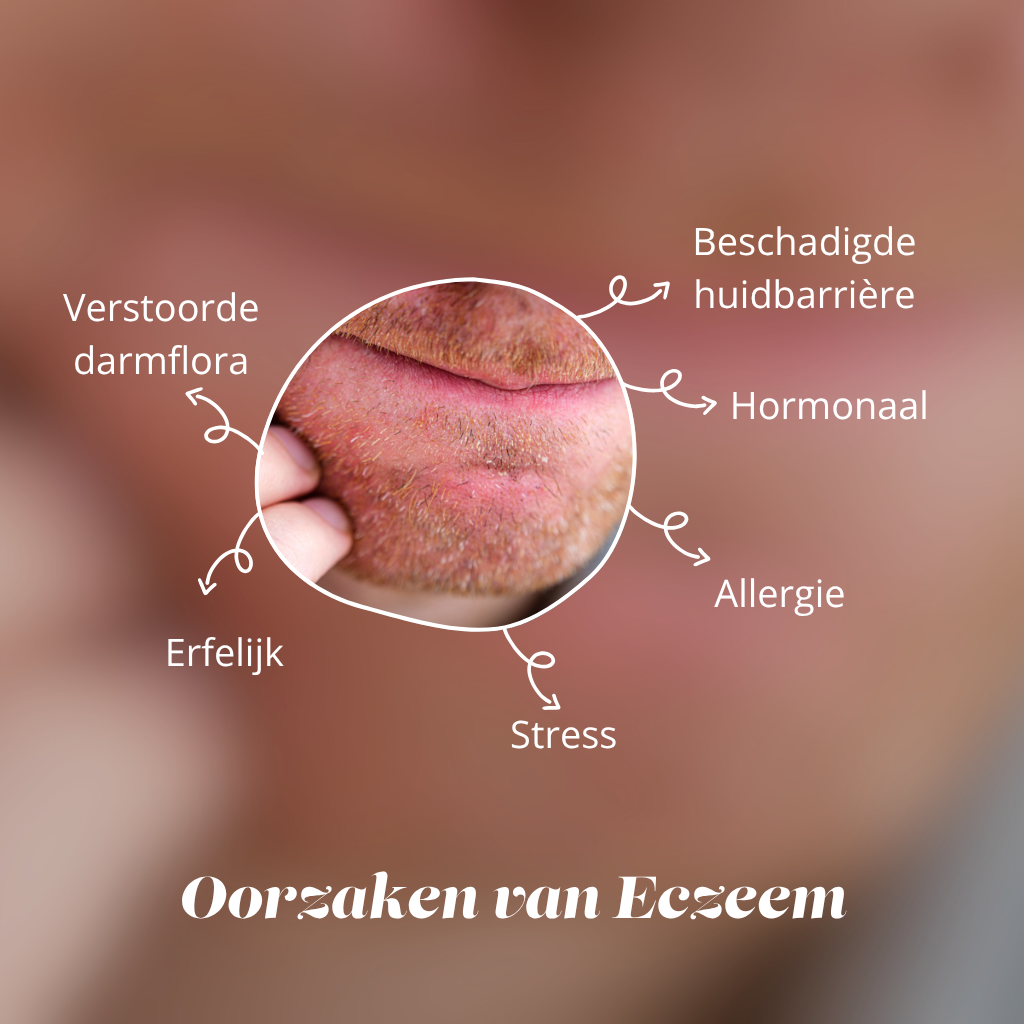 oorzaken van eczeem