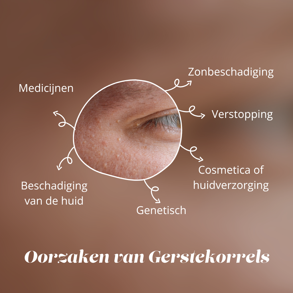 oorzaken van gerstekorrels