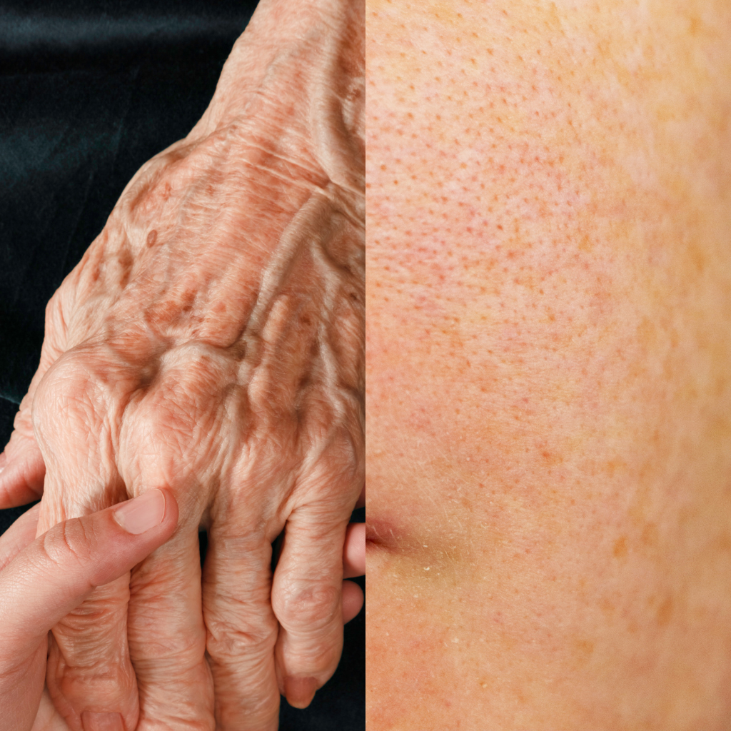 ouderdomsvlekken versus pigmentvlekken