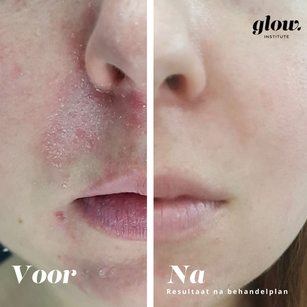 resultaat eczeem behandeling voor en na 