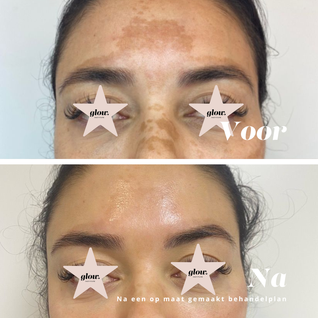 pigmentbehandeling voor en na