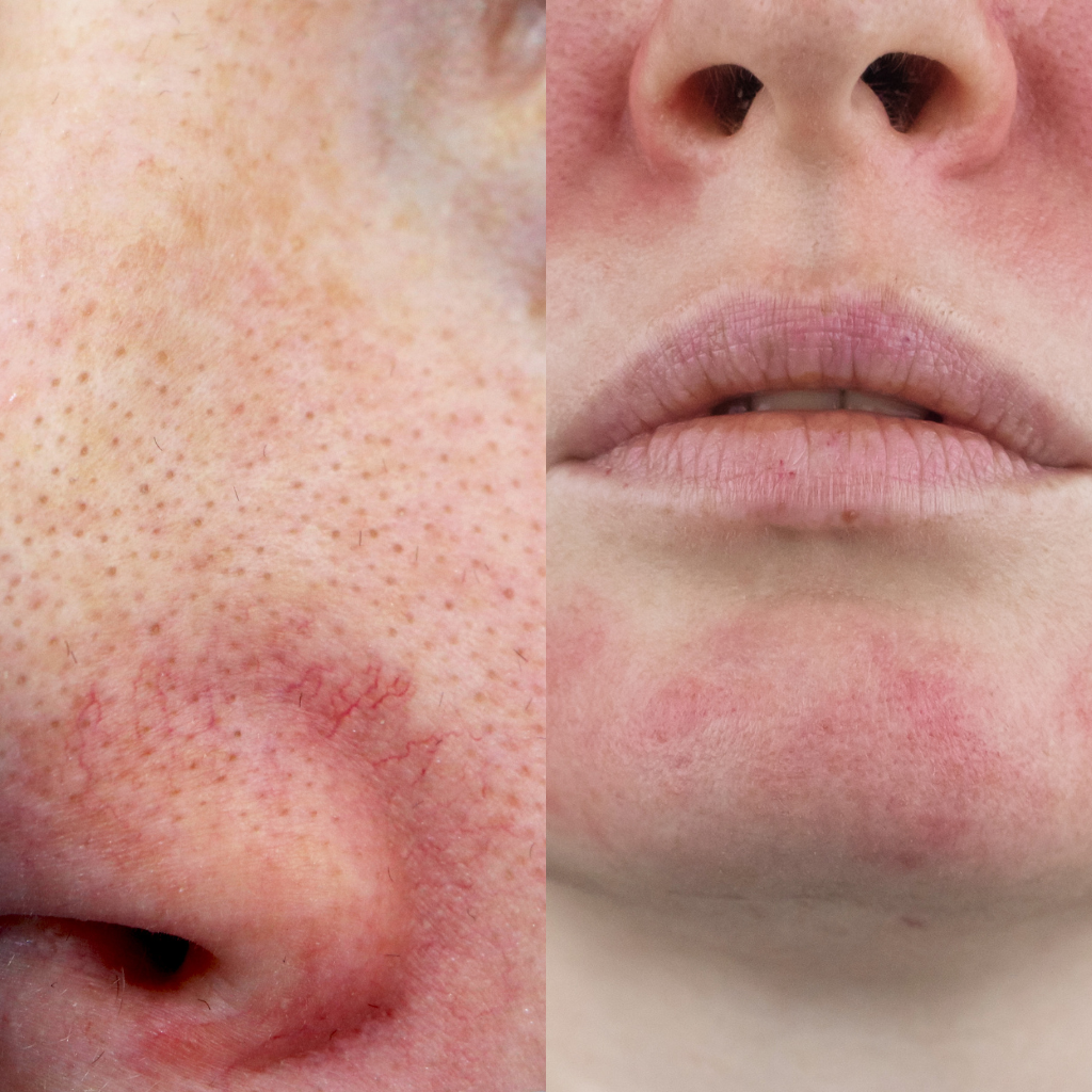 Verschil couperose en rosacea